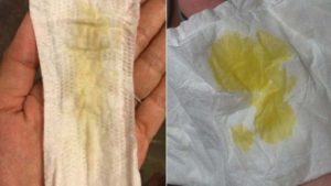 Желтые выделения с кислым запахом