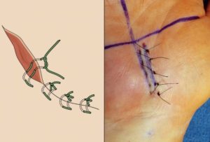 Осталась нитка после снятия швов