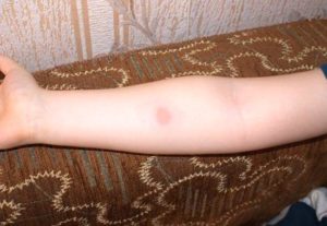 Покраснение после манту