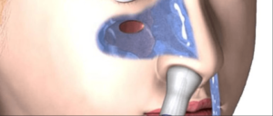 Головокружение после гайморита