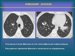 Просветы бронхов умеренно расширены, стенки незначительно уплотнены