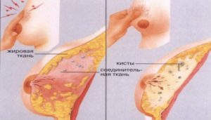 Одна грудь болит перед месячными из за уплотнения
