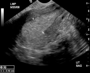 Узи гиперплазия эндометрия