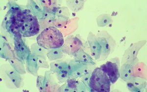 Гарднерелла