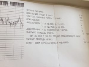 Насколько информативно ктг плода если я не ощущала шевелений