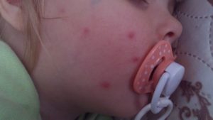 Прыщики на щеке у ребенка