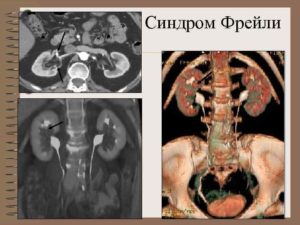 Синдром Фрейли