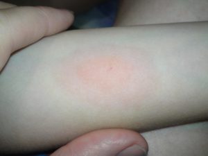 Покраснение после манту