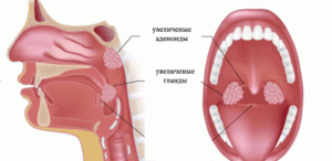 Разрастание ниже миндалины