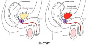 Кишечник давит на мочевой