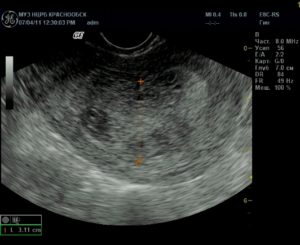 Посла фармаборта по узи остатки хориональной ткани