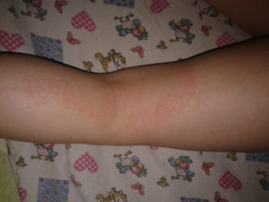 Сыпь на попе и ногах ребенка