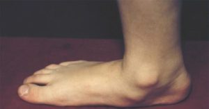 Выпирает косточка на одной стопе у ребенка