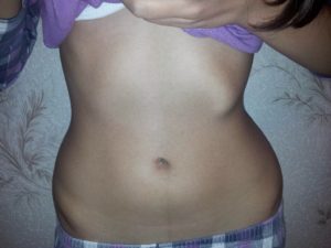 Опухоль на левой стороне ребер в низу