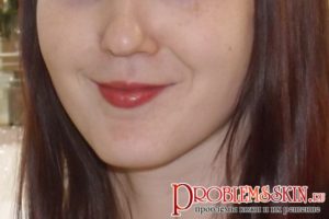 Появились прыщи при приеме Джес