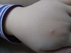 Белый шарик (прыщик) на руке у ребенка