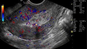 Посла фармаборта по узи остатки хориональной ткани