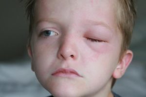 Припухло верхнее веко у ребенка