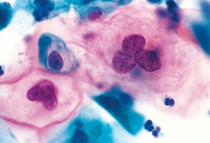 Цитология, обнаружены атипичные клетки