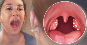 Белые точки на миндалинах