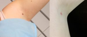 Темные пятна после ран