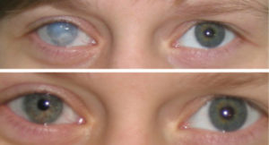 Мутно видит один глаз в линзах