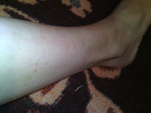 Чешутся ноги после душа