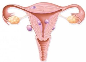 Рак шейки матки Ca Colli uteri T3N0M0