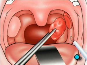 После удаления миндалин