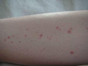 Геморрагическая сыпь при лейкозе