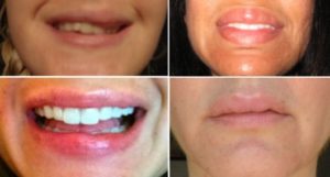 Фиброз после введения филлера в губы