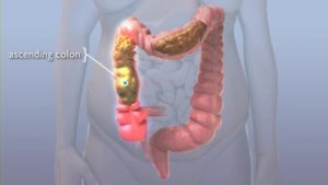 Кал не доходит до прямой кишки