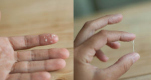 Белые выделения и сгустки из влагалища