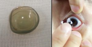 Линза закатилась под верхнее веко, она сама достанется?