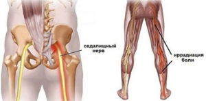 Дергается нерв в ягодице