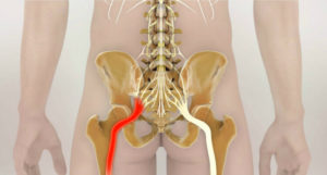 Дергается нерв в ягодице