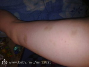 Синяки после тренировки