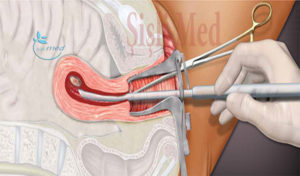 Кровит после удаления спирали