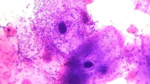 Гарднерелла