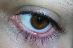 Белый прыщ на веке у ребёнка