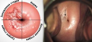 Обнаружили белое пятно на шейке матки