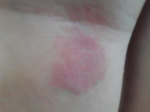 Выпуклые красные пятна на коже, твердые и чешутся