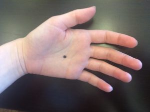 Темные пятна на пальцах рук