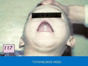 Готическое нёбо