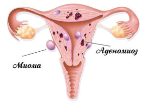 Онкомаркеры, миома матки, аденомиоз