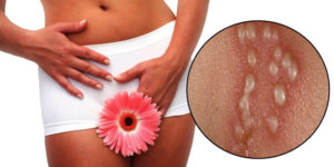 Зуд в интимной области при хорошем мазке