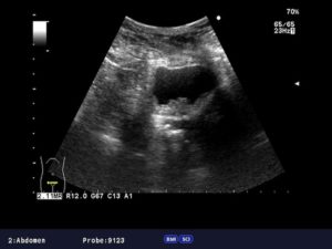 Рак шейки матки 3 степени по УЗИ