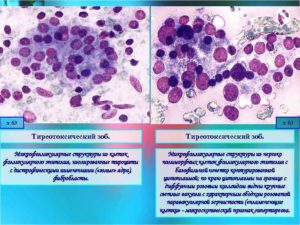 Пролиферация фолликулярного эпителия