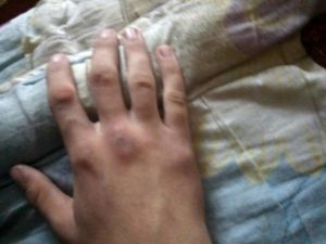 Помогите! Выбил казанок на правой руке мизинца