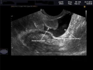 Жидкость в позадиматочном пространстве в первой половине цикла